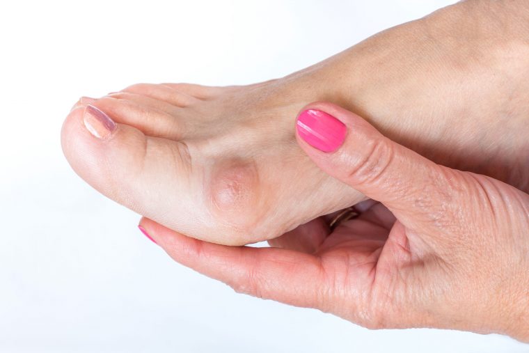 What Can You Do About Bunions?